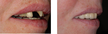 Dental Bridge treatment in London Before and After