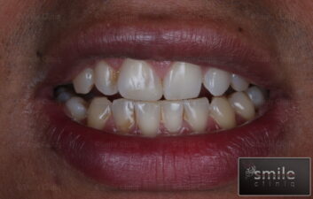 broken front tooth white filling after