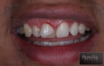 broken front tooth white filling before