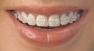 Ceramic Brackets in London