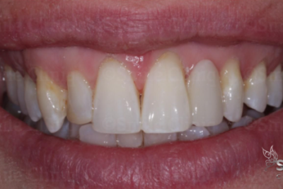 after ceramic bridge finchley dentist