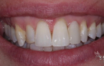 after ceramic bridge finchley dentist