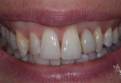 before ceramic bridge finchley dentist