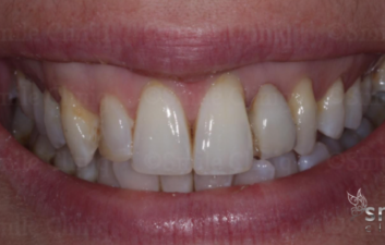 before ceramic bridge finchley dentist