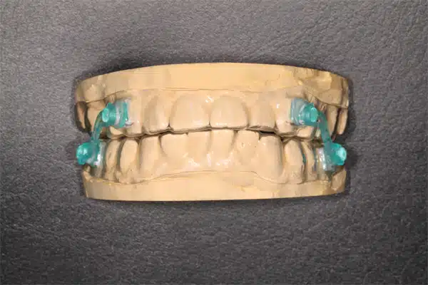 Anti-snoring devices