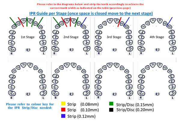 clear braces diagram