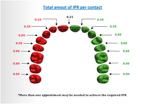 clear braces ipr contact