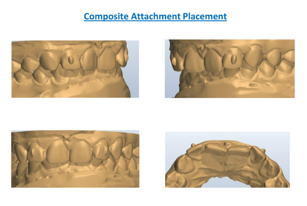 Composite Attachment Placement