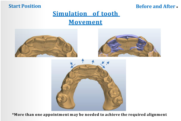 Simulation of tooth movement