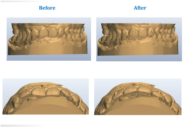 Clear braces before and after