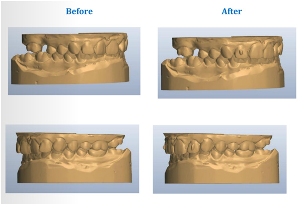 clear-braces8