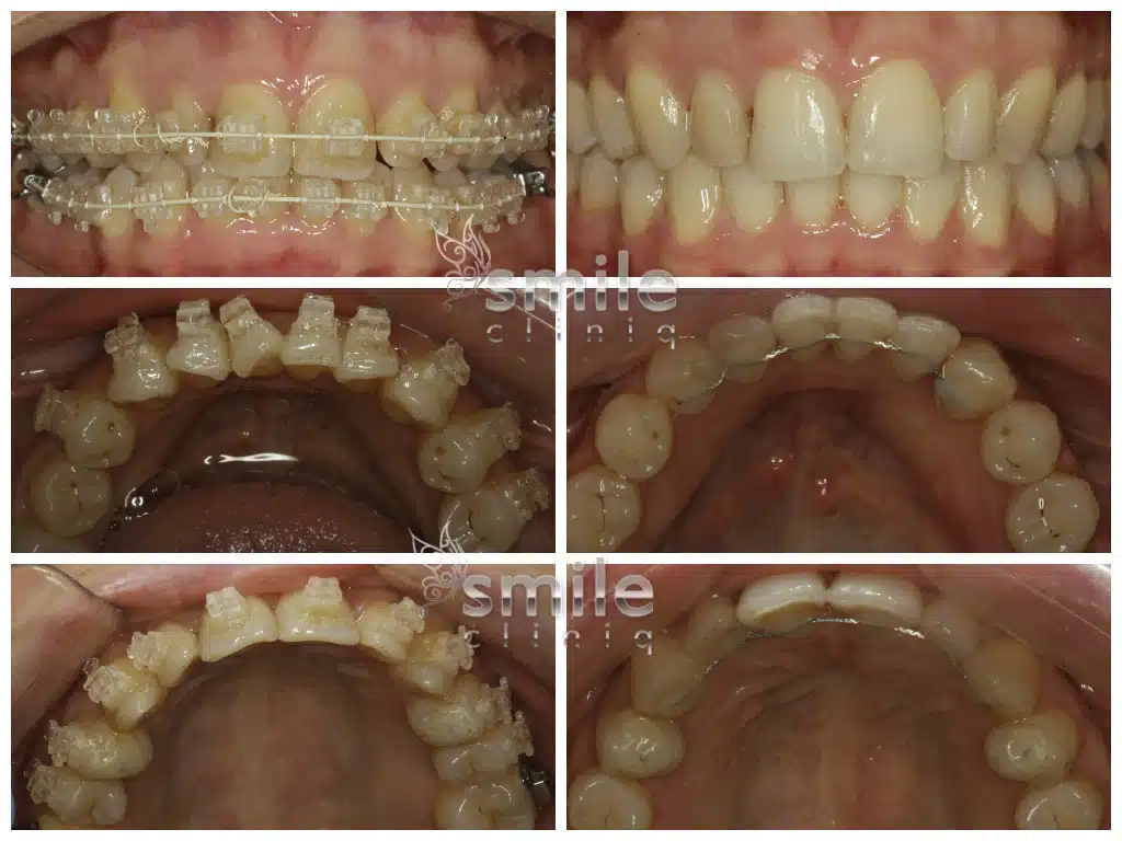 Clear and lingual braces before and after, showing straightened teeth.