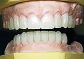 Smile Design Procedure Preoperative Picture