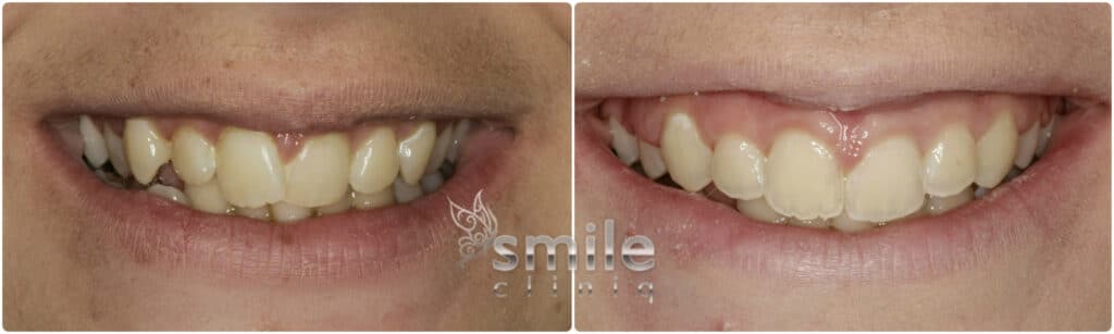 Cosmetic Dental Treatment Before And After Results cosmetic dental treatment before and after results