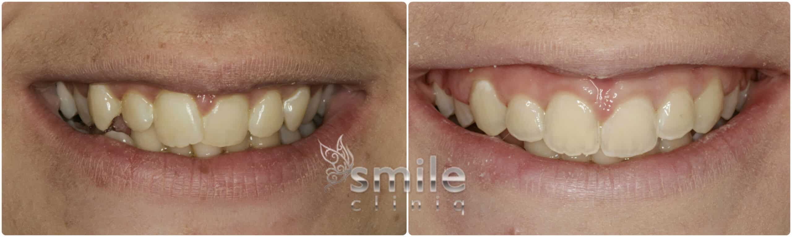 Cosmetic Dental Treatment Before And After Results cosmetic dental treatment before and after results