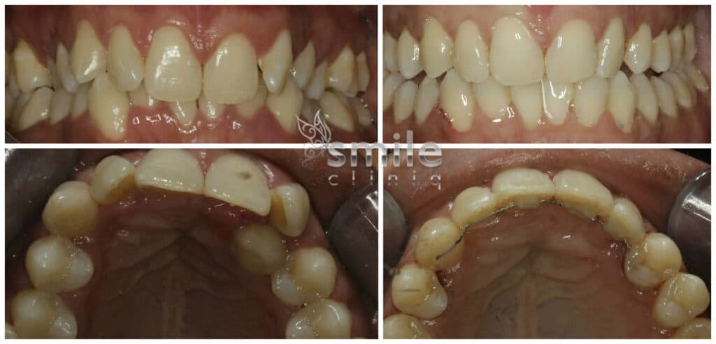 Teeth Before And After Dental Alignment Treatment, Showcasing Straightened Teeth And Corrected Crowding. teeth before and after dental alignment treatment, showcasing straightened teeth and corrected crowding.