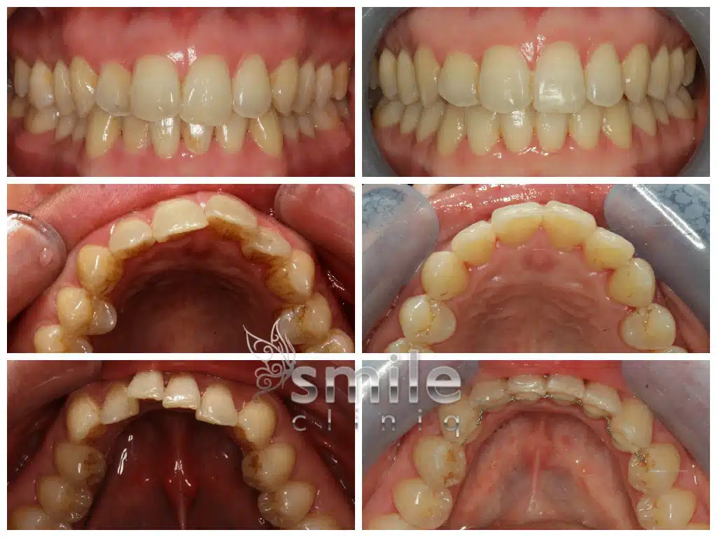 Dental transformation: before and after views of teeth straightened and cleaned.