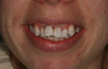 internal_whitening_london_after