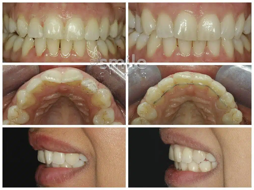 Patient's teeth before and after orthodontic treatment, showing significant alignment and bite improvement.