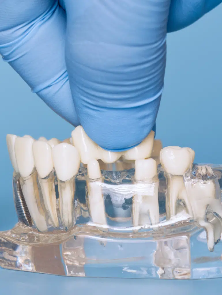 dental bridge london 2