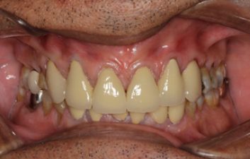 dental-crowns-after