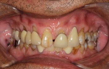 dental-crowns-before