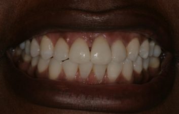 dental-crowns-london-after