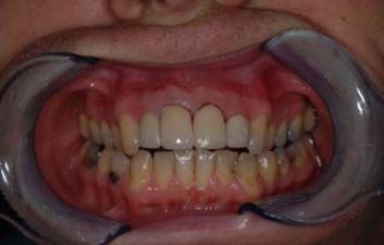 dental-crowns-london-after