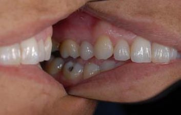 dental-crowns-london-after