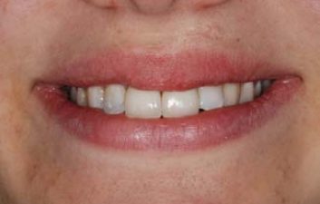 dental-crowns-london-after