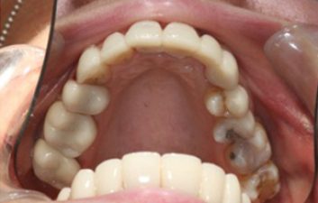 dental-crowns-london-after