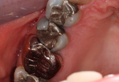Mercury Filling Removal in London Before