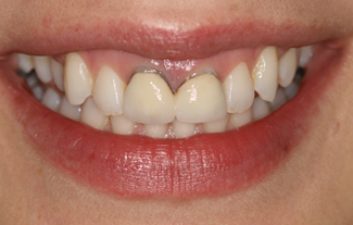 dental-crowns-london-before