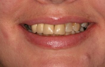 dental-crowns-london-before