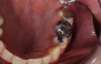 dental-crowns-london-before