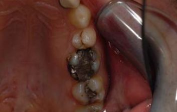 dental-crowns-london-before