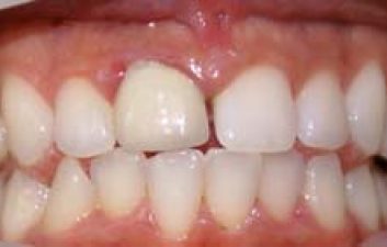 dental-crowns-london-before