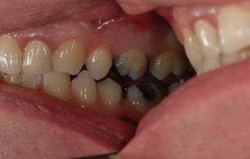 dental-crowns-london-before