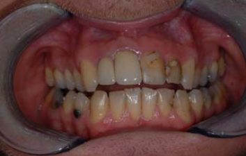 dental-crowns-london-before