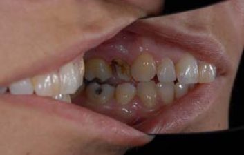 dental-crowns-london-before