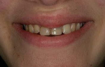 dental-crowns-london-before