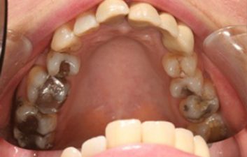 dental-crowns-london-before