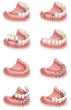 Dental implants graphic