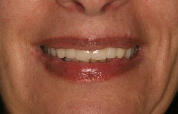 Dental Implants in London After