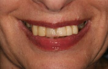 Smile before dental implants