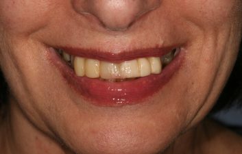 Dental Implants in London Before