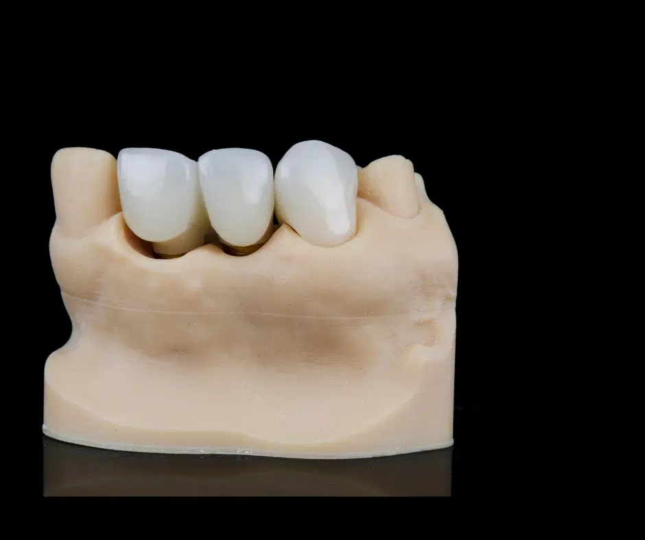 best quality dental bridge in london at smile cliniq
