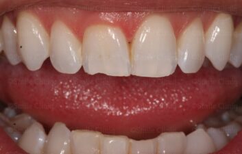 white tooth filling london before
