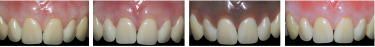 Enigma Cosmetic Denture System for individual colouring