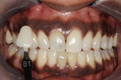 Enlighten Tooth Whitening After